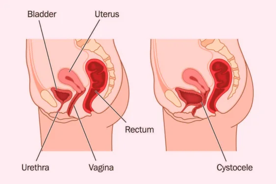 Uterovaginal-Prolapse-and-Urinary-Incontinence-Surgery001