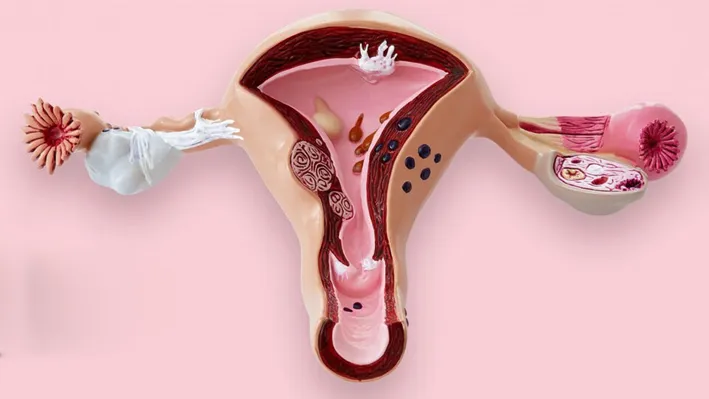 Eliminate Fibroids with Endometriosis Excision Surgery