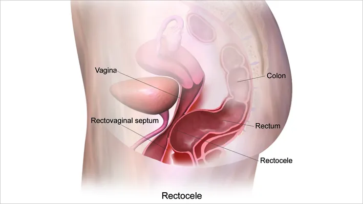 laparoscopic hysterectomy surgery, laparoscopic hysterectomy procedure, laparoscopic ovarian cystectomy, fibroid removal laparoscopic myomectomy