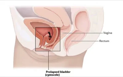 Understanding Uterine Prolapse: Causes, Side Effects, and Treatment Choices