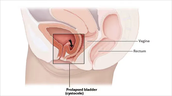 Understanding Uterine Prolapse: Causes, Side Effects, and Treatment Choices