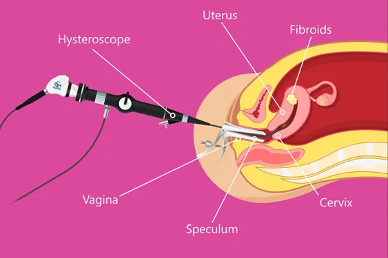 654938649-hysteroscopic-myomectomy-01 hysteroscopy and polyp removal