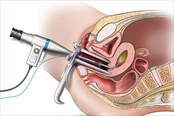 654938670-hysteroscopy-01 endometriosis excision surgery