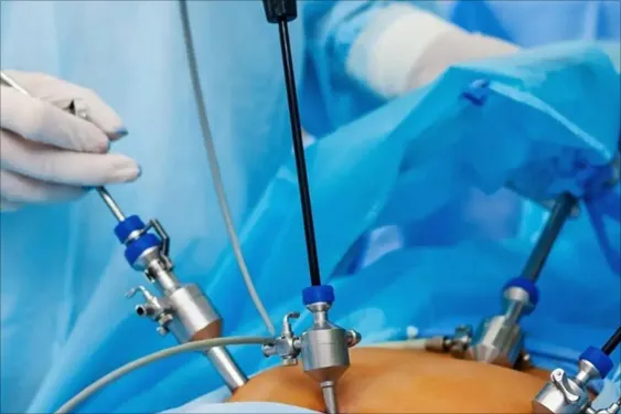 654938682-laparoscopic-endometriosis-gsurgery1-01 endometriosis excision surgery