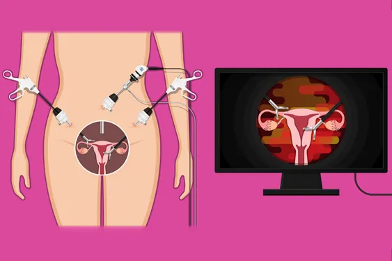 654938697-laparoscopic-myomectomy-01 fibroid removal laparoscopic myomectomy