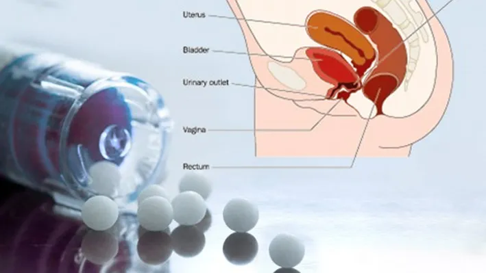 Cystocele