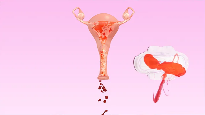 Heavy Menstrual Bleeding