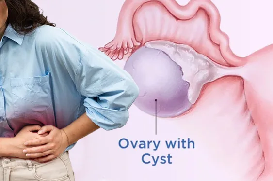 656359661-laparoscopic-ovarian-cystectomy-01 Transobturator Tape Procedure